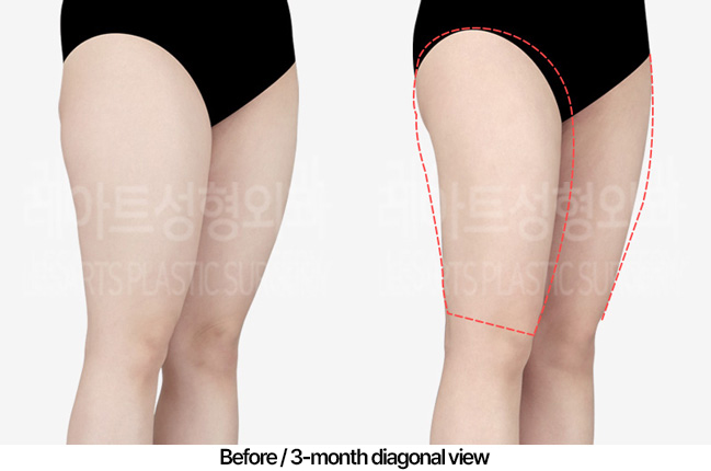 thigh-liposuction_02_04_230416