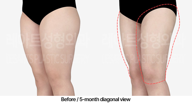 thigh-liposuction_02_05_230409