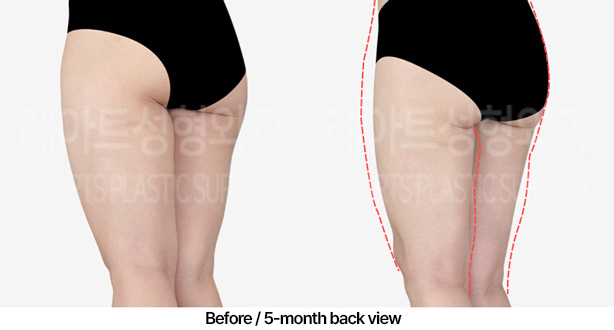 thigh-liposuction_02_06_230409