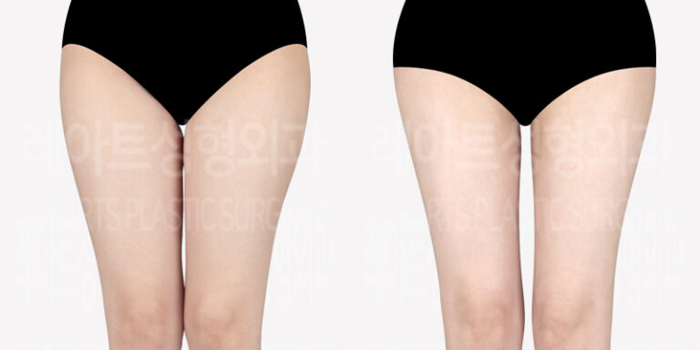 thigh-liposuction_buttocks-fat-transfer-thumbnail_240503