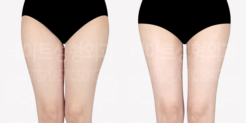 thigh-liposuction_buttocks-fat-transfer-thumbnail_240503