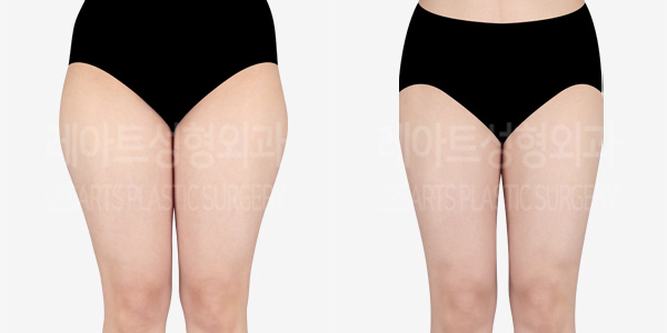 thigh-liposuction_hip-line-thumbnail_240430