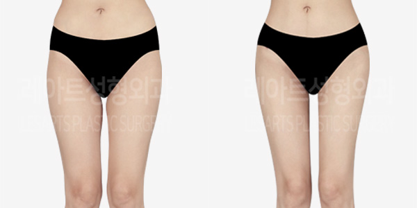 thigh_iposuction-hip_fat_grafting_thumbnail_01_231226