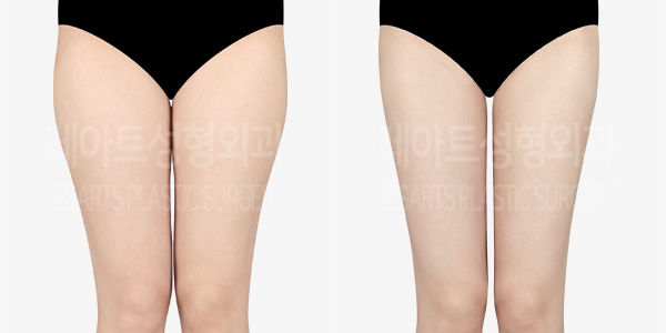 thigh_iposuction-thumbnail-01-240208