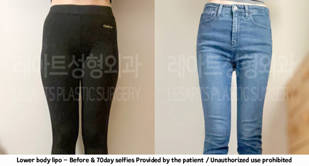 thigh_liposuction-02-02-240208