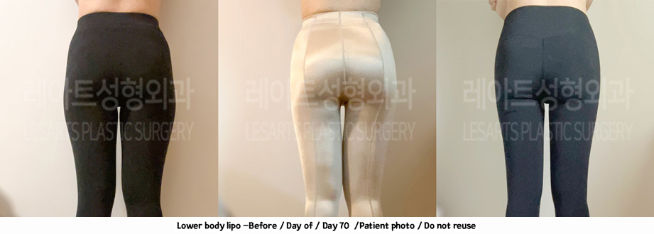 thigh_liposuction-02-03-240208