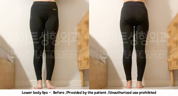thigh_liposuction-02-04-240208