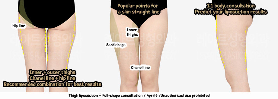 thigh_liposuction-02-05-240208