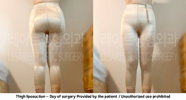 thigh_liposuction-02-06-240208