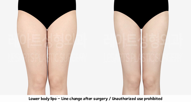 thigh_liposuction-02-07-240208