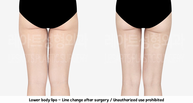 thigh_liposuction-02-08-240208