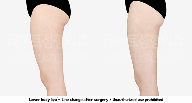 thigh_liposuction-02-09-240208
