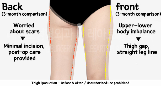 thigh_liposuction-02-10-240208