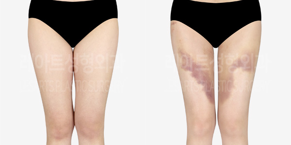 thigh_liposuction_01_thumbnail_231229