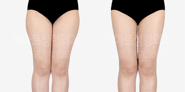 thigh_liposuction_01_thumbnail_240109