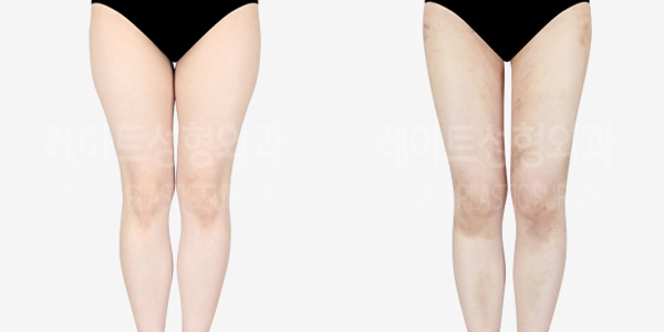 thigh_liposuction_01_thumbnail_240124