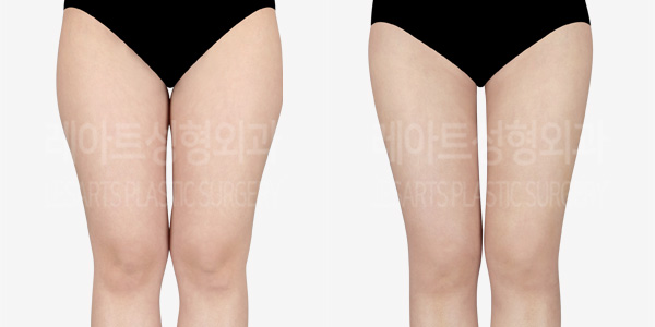 thigh_liposuction_01_thumbnail_240220