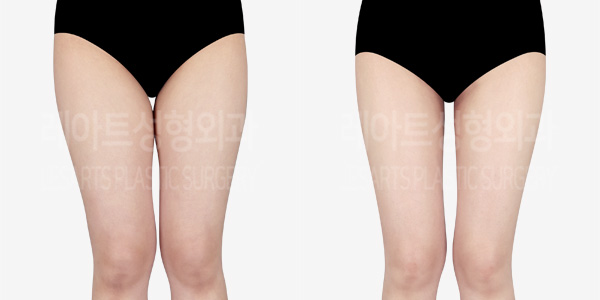 thigh_liposuction_01_thumbnail_240312