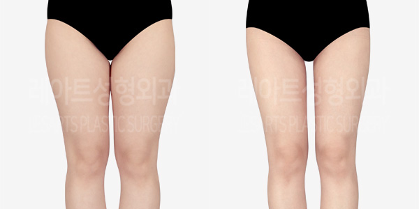 thigh_liposuction_01_thumbnail_240318