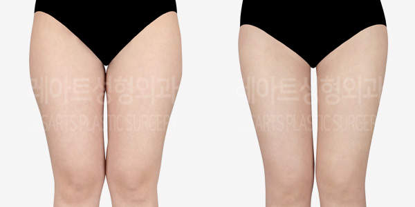 thigh_liposuction_01_thumbnail_240321