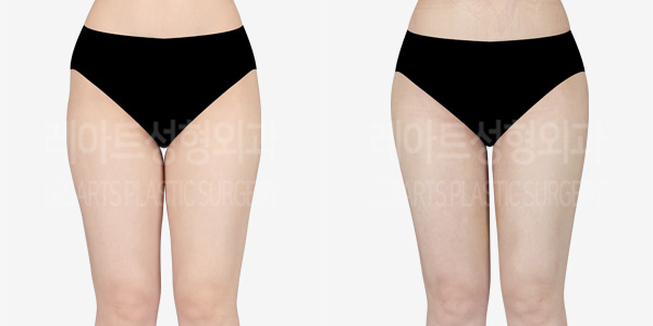 thigh_liposuction_01_thumbnail_240401