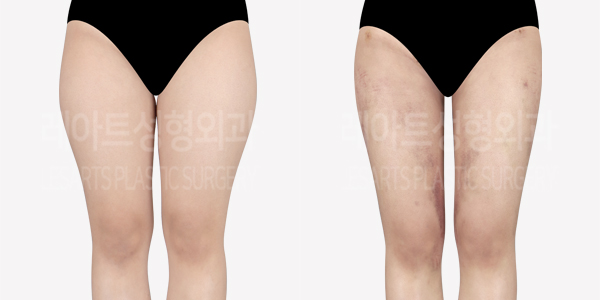 thigh_liposuction_01_thumbnail_240513