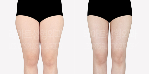 thigh_liposuction_01_thumbnail_240517