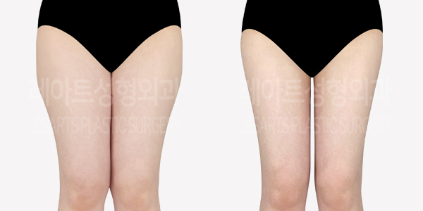thigh_liposuction_01_thumbnail_240603