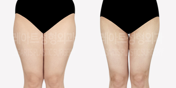 thigh_liposuction_01_thumbnail_240607