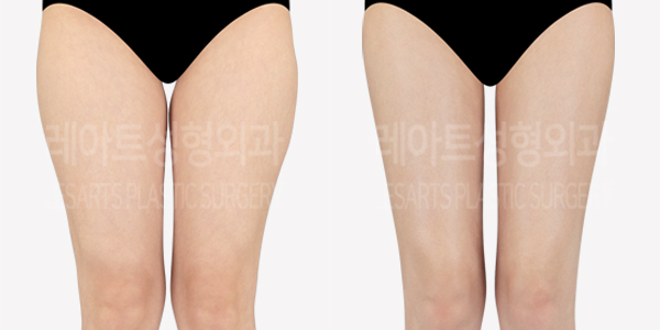 thigh_liposuction_01_thumbnail_240613