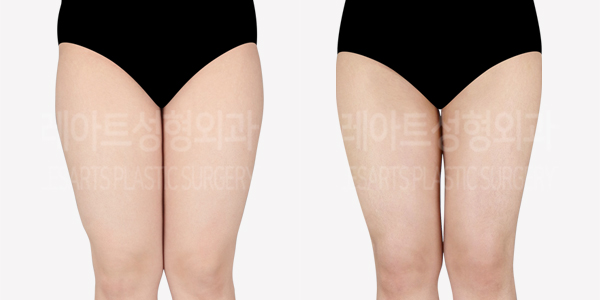 thigh_liposuction_01_thumbnail_240618