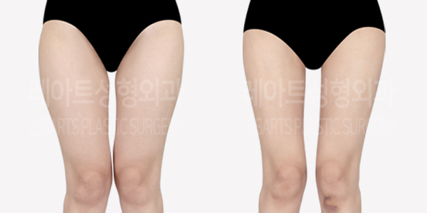 thigh_liposuction_01_thumbnail_240628