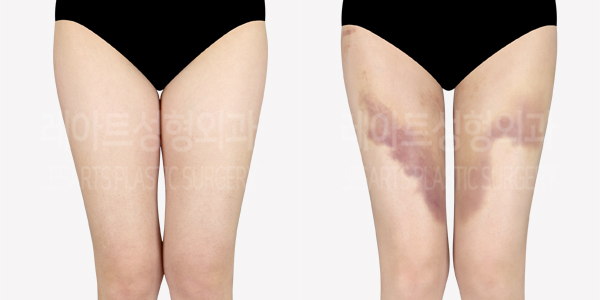 thigh_liposuction_01_thumbnail_240701