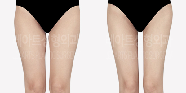 thigh_liposuction_01_thumbnail_240703