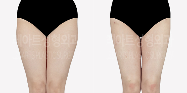 thigh_liposuction_01_thumbnail_240711