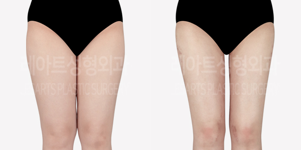 thigh_liposuction_01_thumbnail_240715