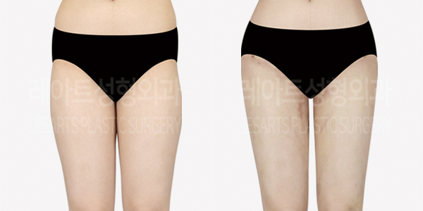 thigh_liposuction_01_thumbnail_240805