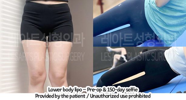 thigh_liposuction_02_01_240109