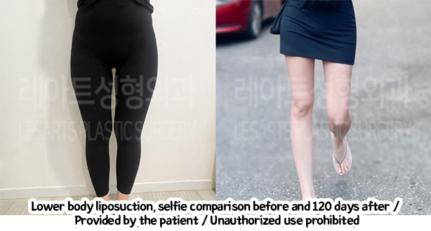 thigh_liposuction_02_01_240220