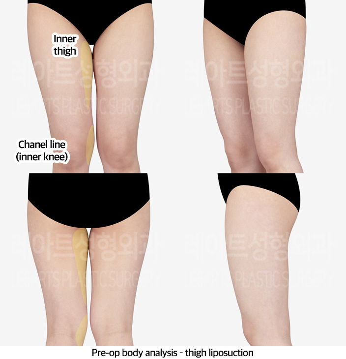 thigh_liposuction_02_01_240312