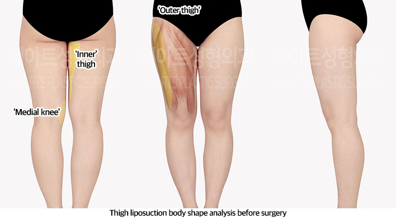 thigh_liposuction_02_01_240318