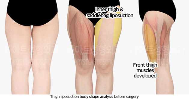 thigh_liposuction_02_01_240321