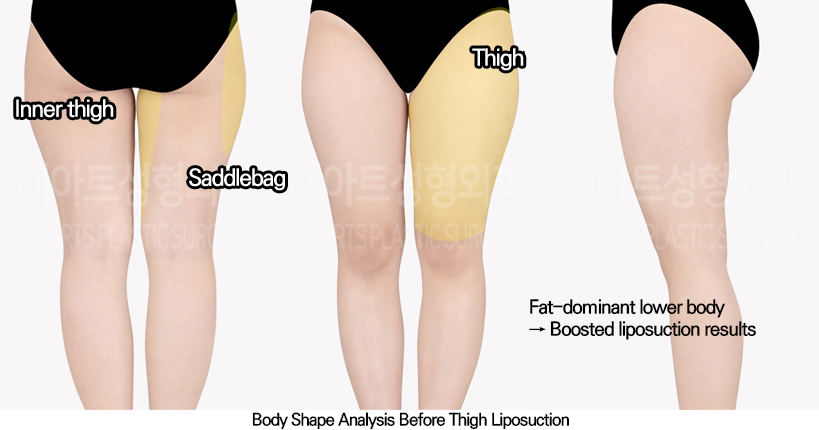 thigh_liposuction_02_01_240513