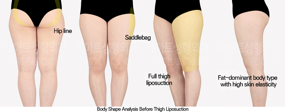 thigh_liposuction_02_01_240517