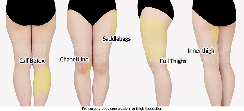 thigh_liposuction_02_01_240603