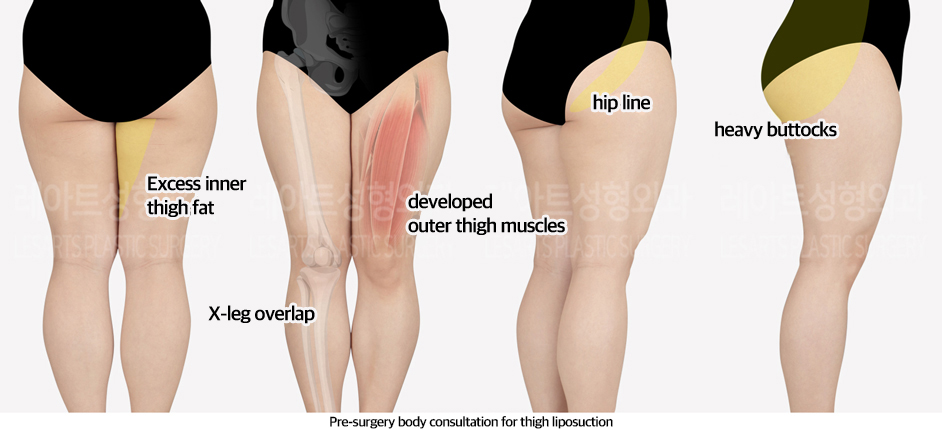 thigh_liposuction_02_01_240607