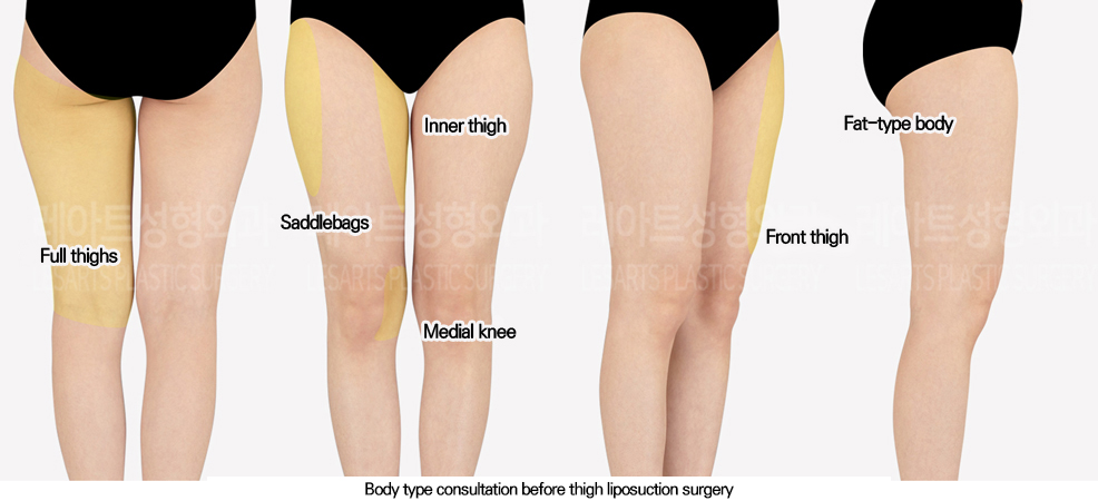 thigh_liposuction_02_01_240613