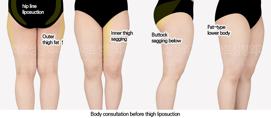 thigh_liposuction_02_01_240618
