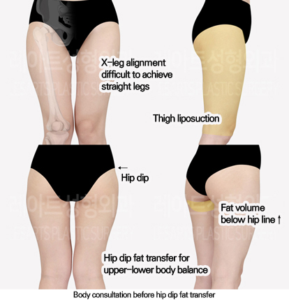 thigh_liposuction_02_01_240628