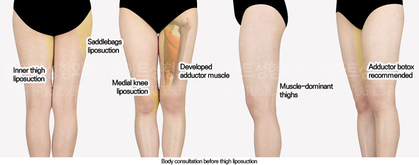 thigh_liposuction_02_01_240701